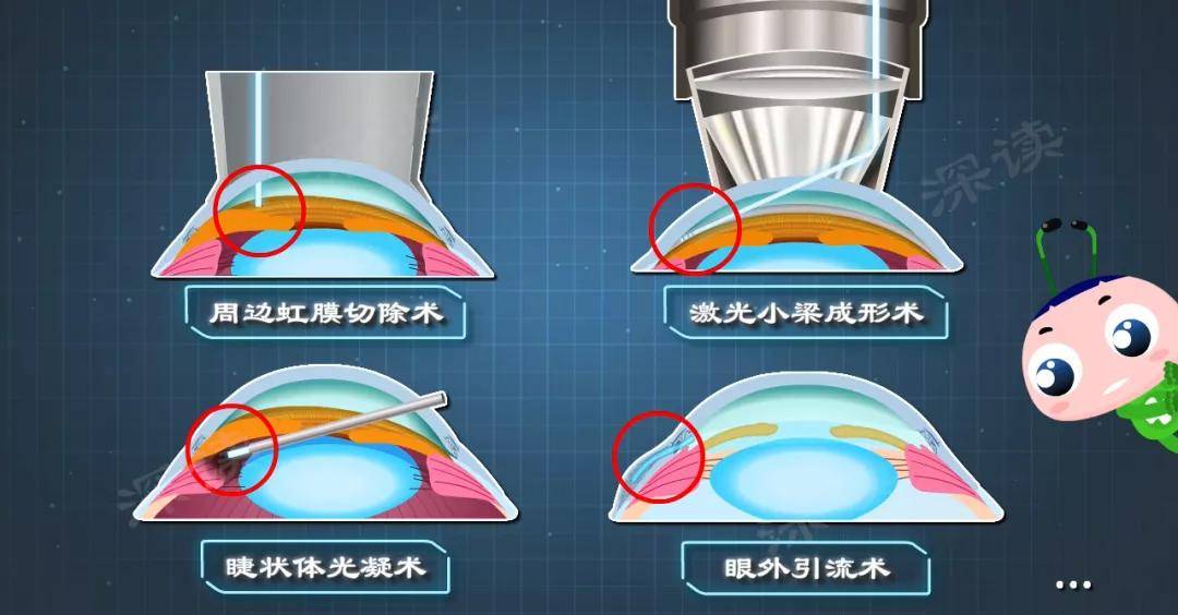 参天公司宣布青光眼引流器系统上市许可申请获得CMDE受理